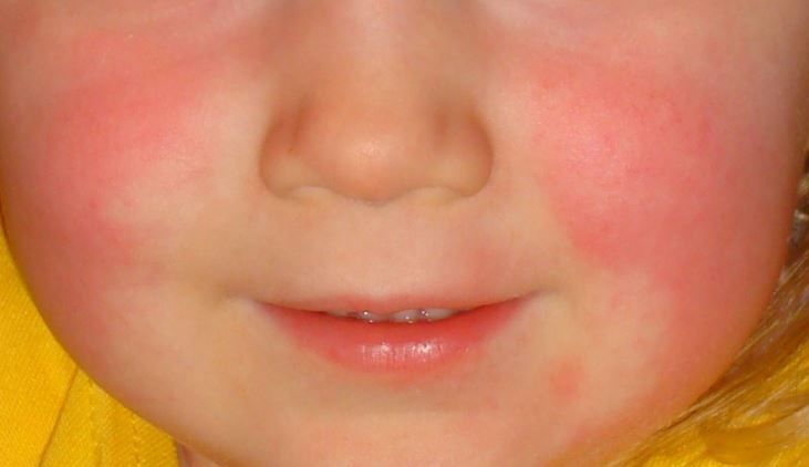 Comment traiter la scarlatine ?